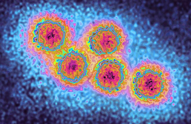 Hepatitis A